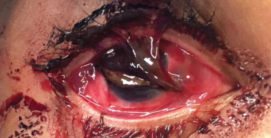 Can Welding Cause Glaucoma? Uncover the Truth